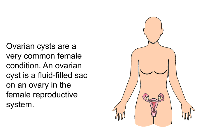 Ovarian cysts are a very common female condition. An ovarian cyst is a fluid-filled sac on an ovary in the female reproductive system.