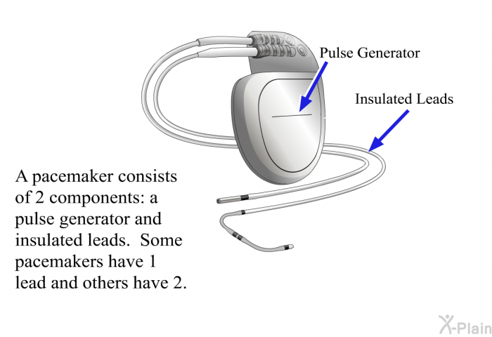 A pacemaker consists of 2 components: a pulse generator and insulated leads. Some pacemakers have 1 lead and others have 2.