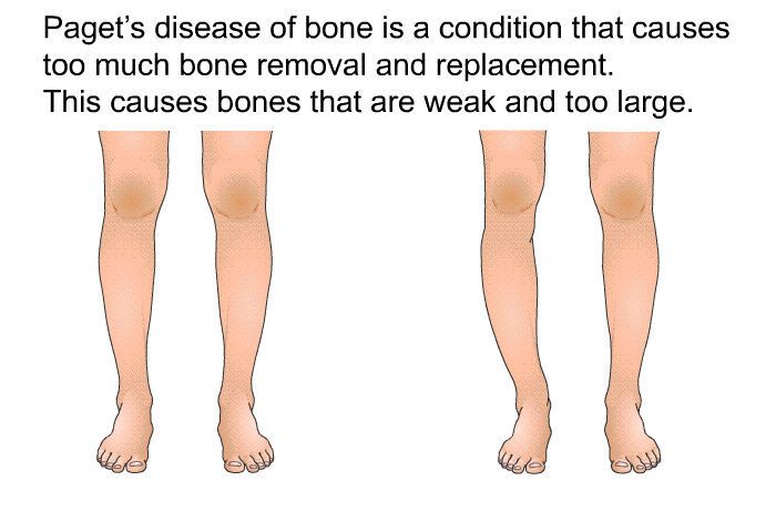 Paget's disease of bone is a condition that causes too much bone removal and replacement. This causes bones that are weak and too large.