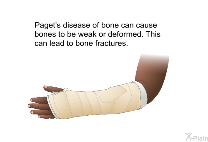 Paget's disease of bone can cause bones to be weak or deformed. This can lead to bone fractures.