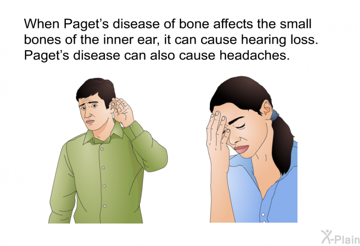 When Paget's disease of bone affects the small bones of the inner ear, it can cause hearing loss. Paget's disease can also cause headaches.