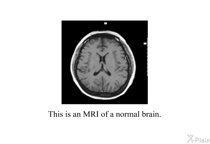 This is an MRI of a normal brain.