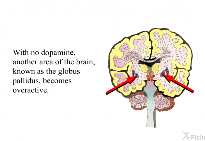 With no dopamine, another area of the brain, known as the globus pallidus, becomes overactive.