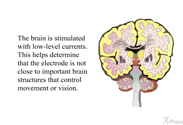 The brain is stimulated with low-level currents. This helps determine that the electrode is not close to important brain structures that control movement or vision.