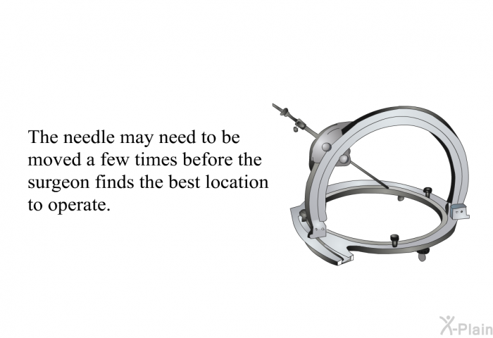 The needle may need to be moved a few times before the surgeon finds the best location to operate.