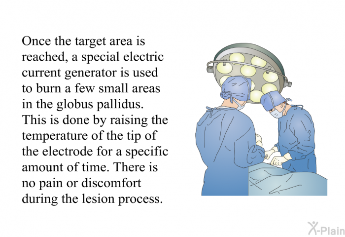 Once the target area is reached, a special electric current generator is used to burn a few small areas in the globus pallidus. This is done by raising the temperature of the tip of the electrode for a specific amount of time. There is no pain or discomfort during the lesion process.