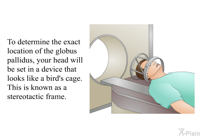 To determine the exact location of the globus pallidus, your head will be set in a device that looks like a bird's cage. This is known as a stereotactic frame.