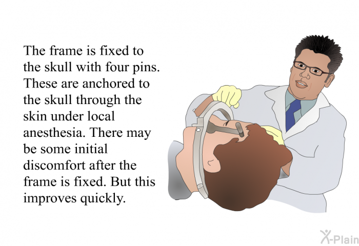 The frame is fixed to the skull with four pins. These are anchored to the skull through the skin under local anesthesia. There may be some initial discomfort after the frame is fixed. But this improves quickly.