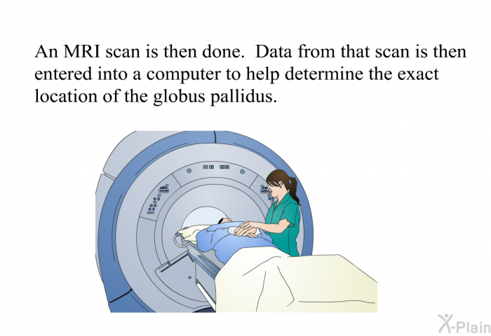 An MRI scan is then done. Data from that scan is then entered into a computer to help determine the exact location of the globus pallidus.