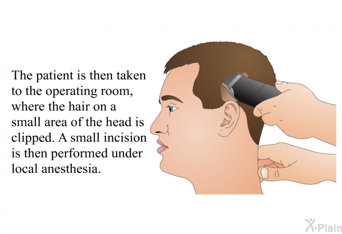 The patient is then taken to the operating room, where the hair on a small area of the head is clipped. A small incision is then performed under local anesthesia.