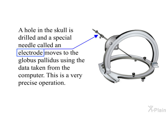 A hole in the skull is drilled and a special needle called an electrode moves to the globus pallidus using the data taken from the computer. This is a very precise operation.