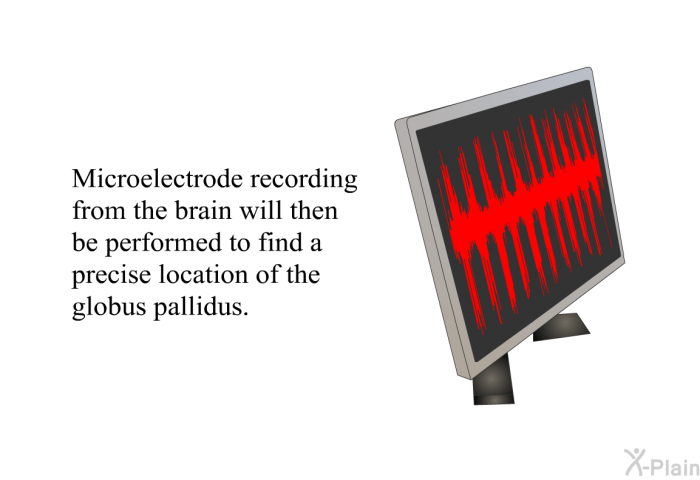 Microelectrode recording from the brain will then be performed to find a precise location of the globus pallidus.