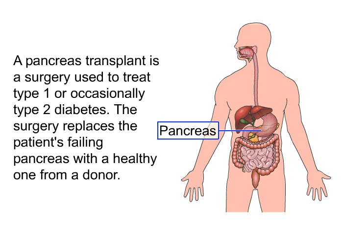 A pancreas transplant is a surgery used to treat type 1 or occasionally type 2 diabetes. The surgery replaces the patient's failing pancreas with a healthy one from a donor.