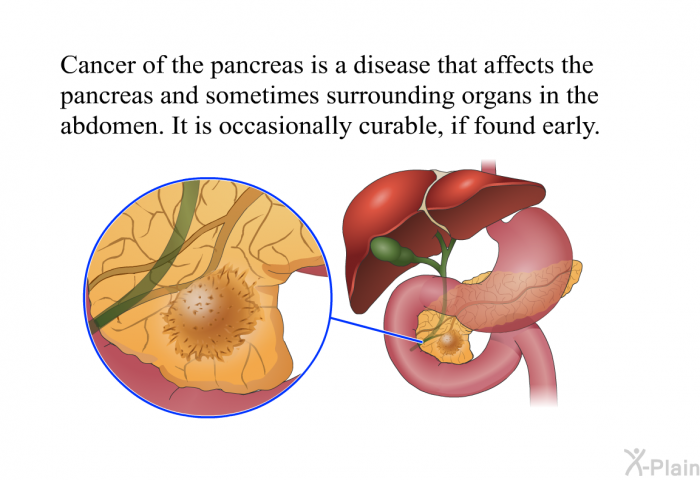 Cancer of the pancreas is a disease that affects the pancreas and sometimes surrounding organs in the abdomen. It is occasionally curable, if found early.
