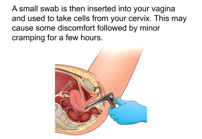 A small swab is then inserted into your vagina and used to take cells from your cervix. This may cause some discomfort followed by minor cramping for a few hours.