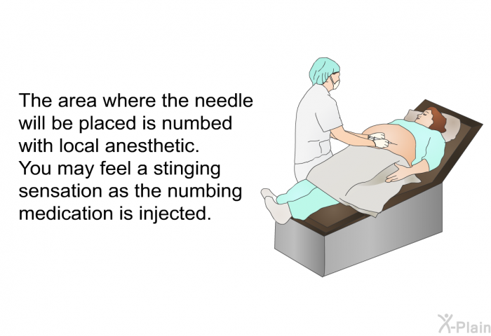 The area where the needle will be placed is numbed with local anesthetic. You may feel a stinging sensation as the numbing medication is injected.