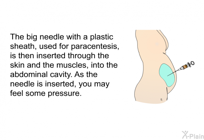 The big needle with a plastic sheath, used for paracentesis, is then inserted through the skin and the muscles, into the abdominal cavity. As the needle is inserted, you may feel some pressure.