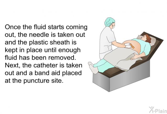 Once the fluid starts coming out, the needle is taken out and the plastic sheath is kept in place until enough fluid has been removed. Next, the catheter is taken out and a band aid placed at the puncture site.