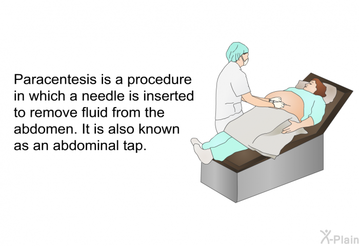 Paracentesis is a procedure in which a needle is inserted to remove fluid from the abdomen. It is also known as an abdominal tap.