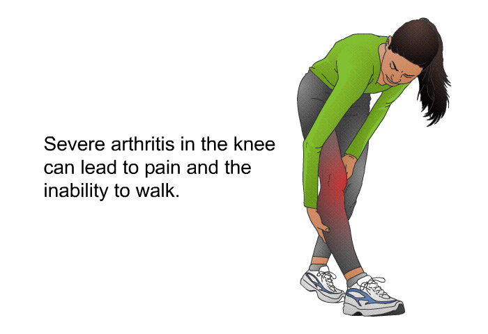 Severe arthritis in the knee can lead to pain and the inability to walk.