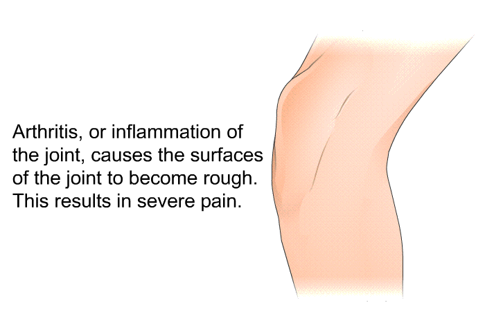 Arthritis, or inflammation of the joint, causes the surfaces of the joint to become rough. This results in severe pain.
