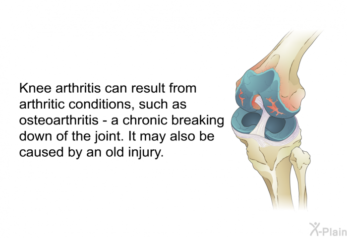 Knee arthritis can result from arthritic conditions, such as osteoarthritis - a chronic breaking down of the joint. It may also be caused by an old injury.