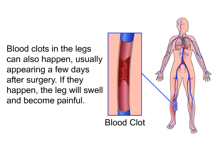 Blood clots in the legs can also happen, usually appearing a few days after surgery. If they happen, the leg will swell and become painful.