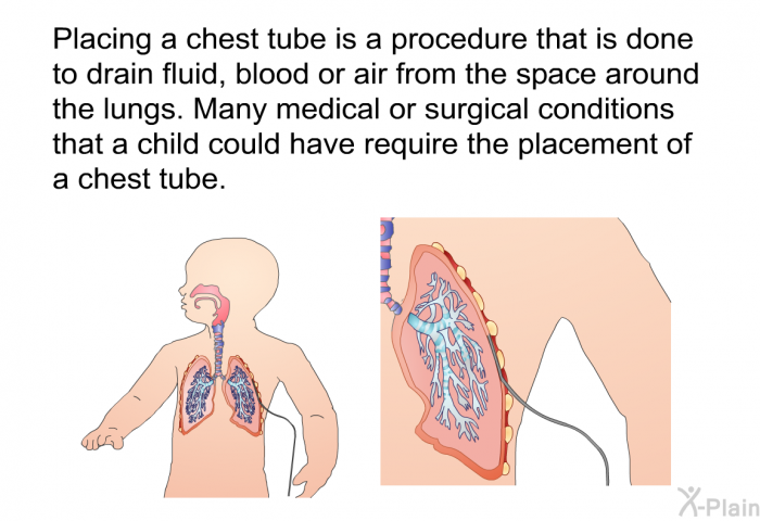 Placing a chest tube is a procedure that is done to drain fluid, blood or air from the space around the lungs. Many medical or surgical conditions that a child could have require the placement of a chest tube.