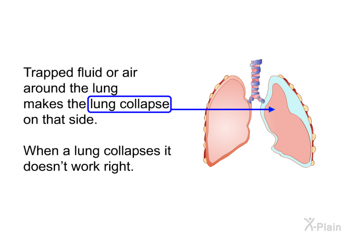 Trapped fluid or air around the lung makes the lung collapse on that side. When a lung collapses it doesn't work right.
