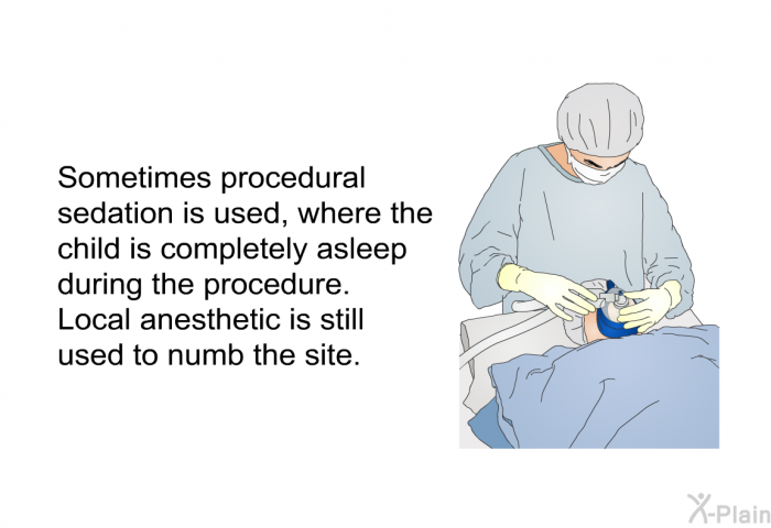Sometimes procedural sedation is used, where the child is completely asleep during the procedure. Local anesthetic is still used to numb the site.