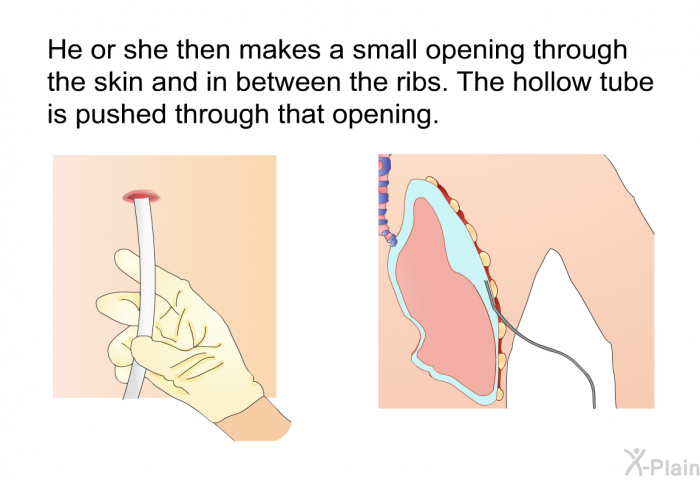 He or she then makes a small opening through the skin and in between the ribs. The hollow tube is pushed through that opening.