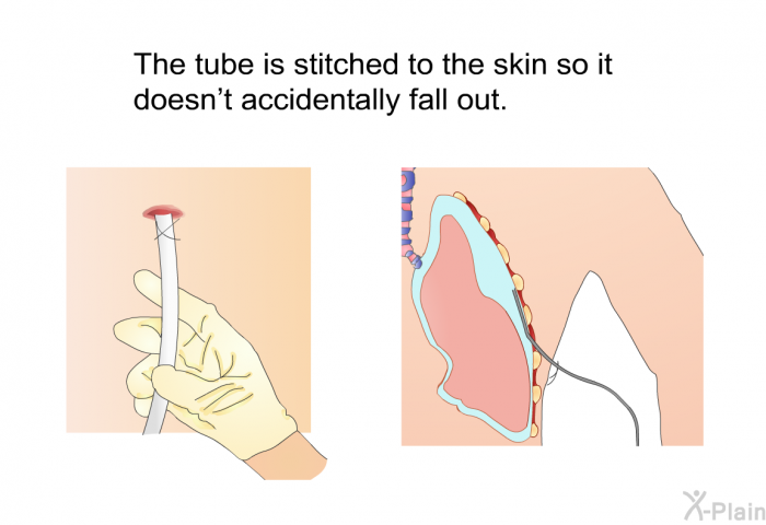 The tube is stitched to the skin so it doesn't accidentally fall out.