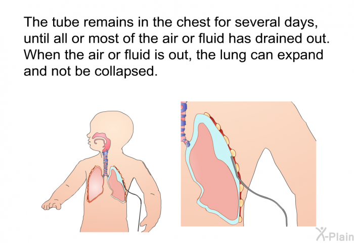 The tube remains in the chest for several days, until all or most of the air or fluid has drained out. When the air or fluid is out, the lung can expand and not be collapsed.