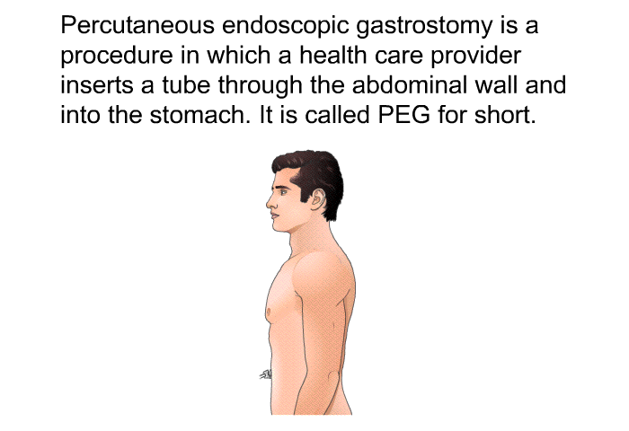 Percutaneous endoscopic gastrostomy is a procedure in which a health care provider inserts a tube through the abdominal wall and into the stomach. It is called PEG for short.
