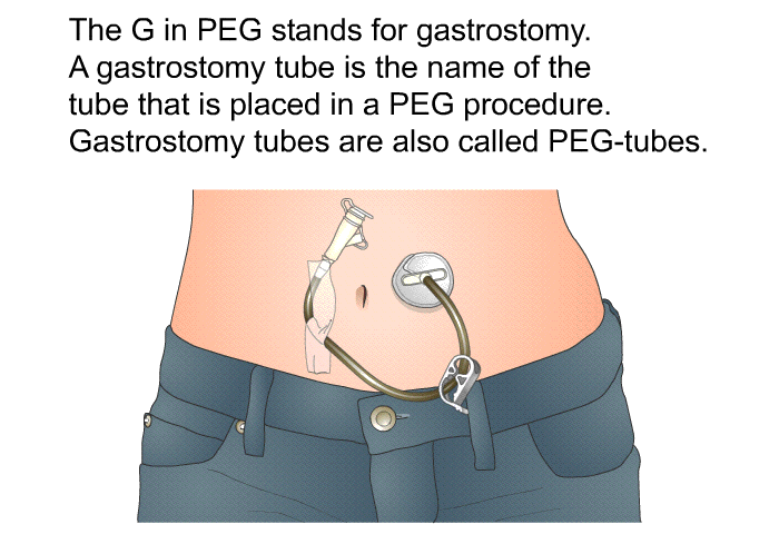 The G in PEG stands for gastrostomy. A gastrostomy tube is the name of the tube that is placed in a PEG procedure. Gastrostomy tubes are also called PEG-tubes.
