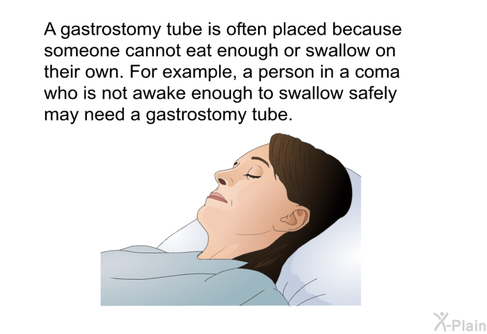 A gastrostomy tube is often placed because someone cannot eat enough or swallow on their own. For example, a person in a coma who is not awake enough to swallow safely may need a gastrostomy tube.