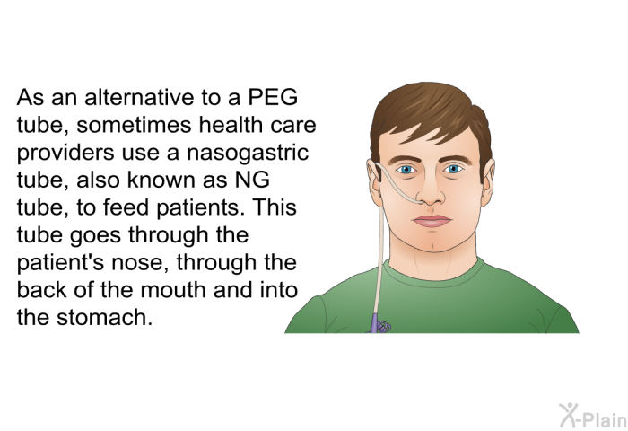 As an alternative to a PEG tube, sometimes health care providers use a nasogastric tube, also known as NG tube, to feed patients. This tube goes through the patient's nose, through the back of the mouth and into the stomach.