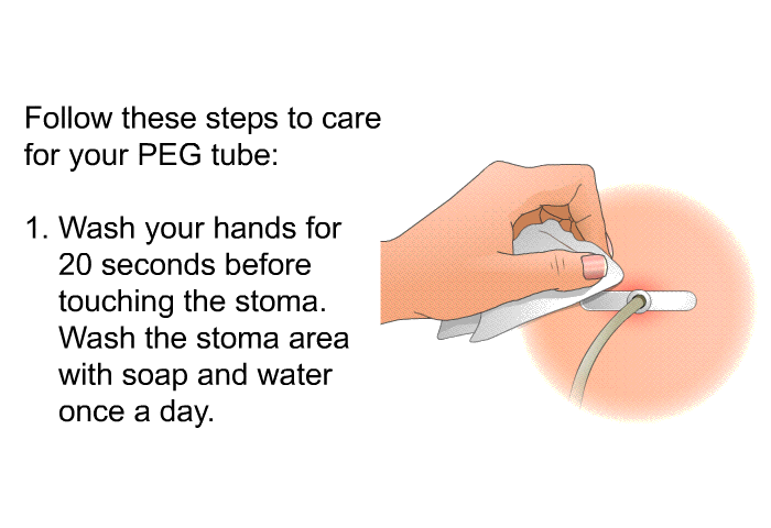 Follow these steps to care for your PEG tube:  Wash your hands for 20 seconds before touching the stoma. Wash the stoma area with soap and water once a day.
