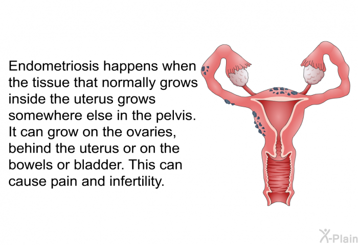 Endometriosis happens when the tissue that normally grows inside the uterus grows somewhere else in the pelvis. It can grow on the ovaries, behind the uterus or on the bowels or bladder. This can cause pain and infertility.