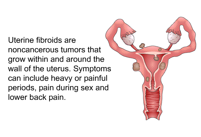 Uterine fibroids are noncancerous tumors that grow within and around the wall of the uterus. Symptoms can include heavy or painful periods, pain during sex and lower back pain.