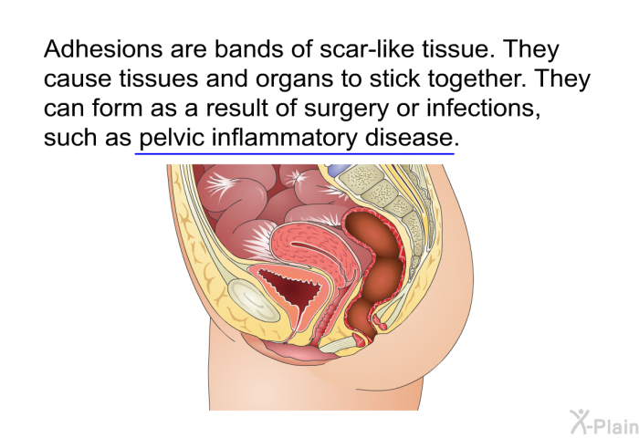 Adhesions are bands of scar-like tissue. They cause tissues and organs to stick together. They can form as a result of surgery or infections, such as pelvic inflammatory disease.