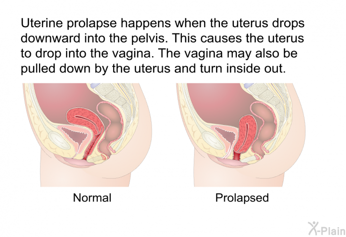 Uterine prolapse happens when the uterus drops downward into the pelvis. This causes the uterus to drop into the vagina. The vagina may also be pulled down by the uterus and turn inside out.