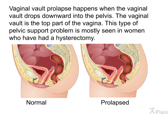 Vaginal vault prolapse happens when the vaginal vault drops downward into the pelvis. The vaginal vault is the top part of the vagina. This type of pelvic support problem is mostly seen in women who have had a hysterectomy.