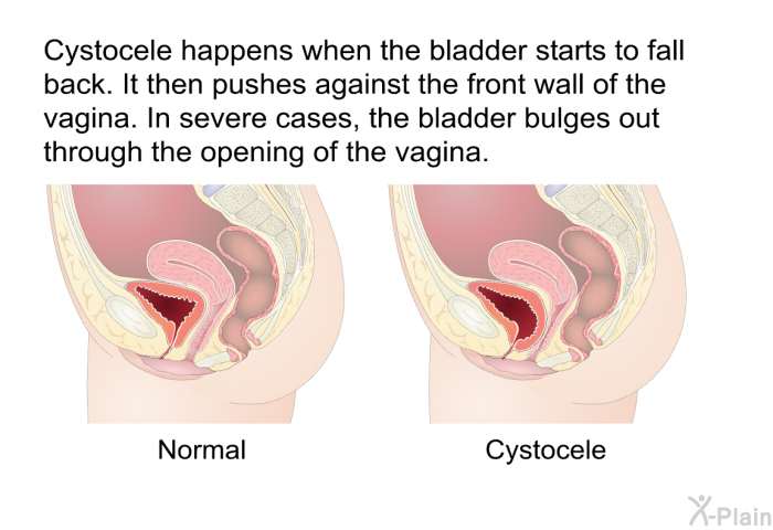 Cystocele happens when the bladder starts to fall back. It then pushes against the front wall of the vagina. In severe cases, the bladder bulges out through the opening of the vagina.