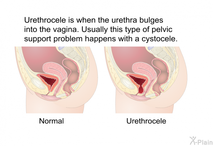 Urethrocele is when the urethra bulges into the vagina. Usually this type of pelvic support problem happens with a cystocele.