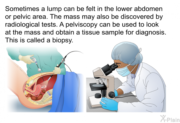 Sometimes a lump can be felt in the lower abdomen or pelvic area. The mass may also be discovered by radiological tests. A pelviscopy can be used to look at the mass and obtain a tissue sample for diagnosis. This is called a biopsy.