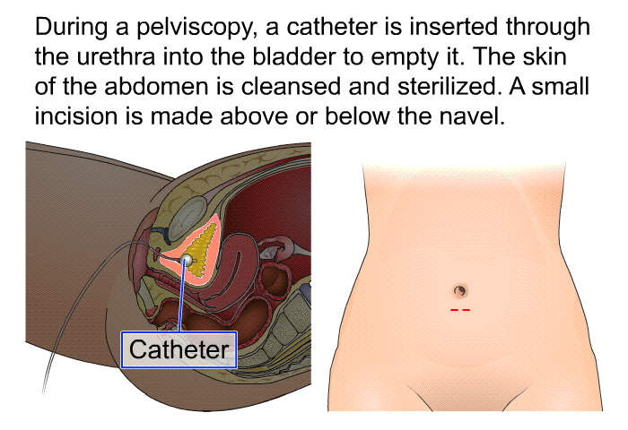 During a pelviscopy, a catheter is inserted through the urethra into the bladder to empty it. The skin of the abdomen is cleansed and sterilized. A small incision is made above or below the navel.