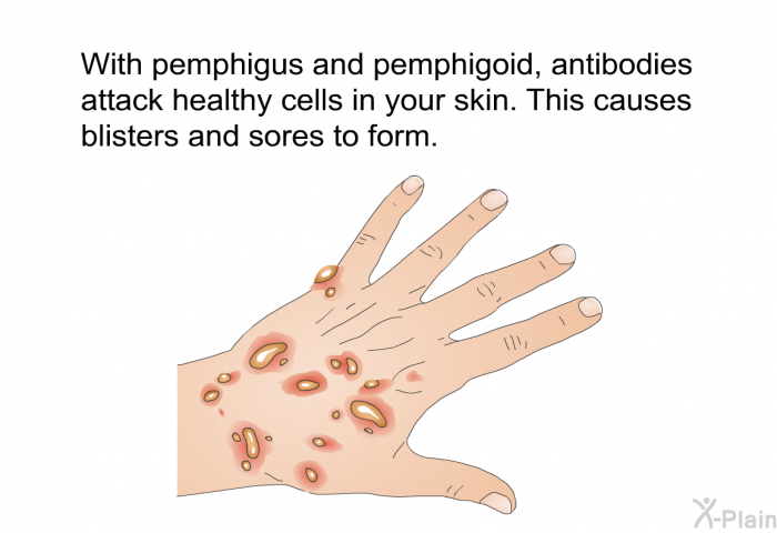 With pemphigus and pemphigoid, antibodies attack healthy cells in your skin. This causes blisters and sores to form.