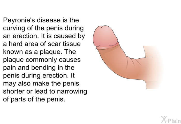 Peyronie's disease is the curving of the penis during an erection. It is caused by a hard area of scar tissue known as a plaque. The plaque commonly causes pain and bending in the penis during erection. It may also make the penis shorter or lead to narrowing of parts of the penis.