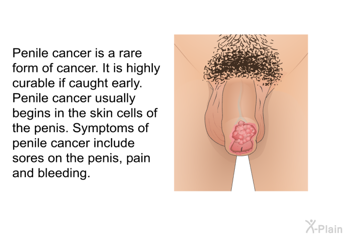Penile cancer is a rare form of cancer. It is highly curable if caught early. Penile cancer usually begins in the skin cells of the penis. Symptoms of penile cancer include sores on the penis, pain and bleeding.
